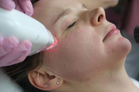 Лазерная косметология лечит постакне
